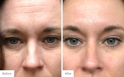 3 - Before and After Real Results image of a woman's face.